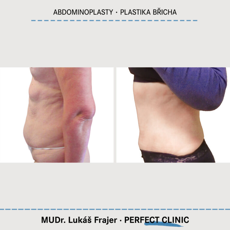 Abdominoplasty