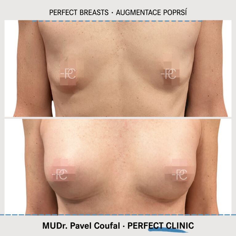 Augmentace poprsí