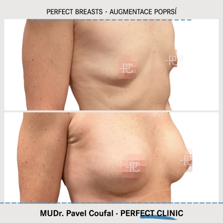Augmentace poprsí