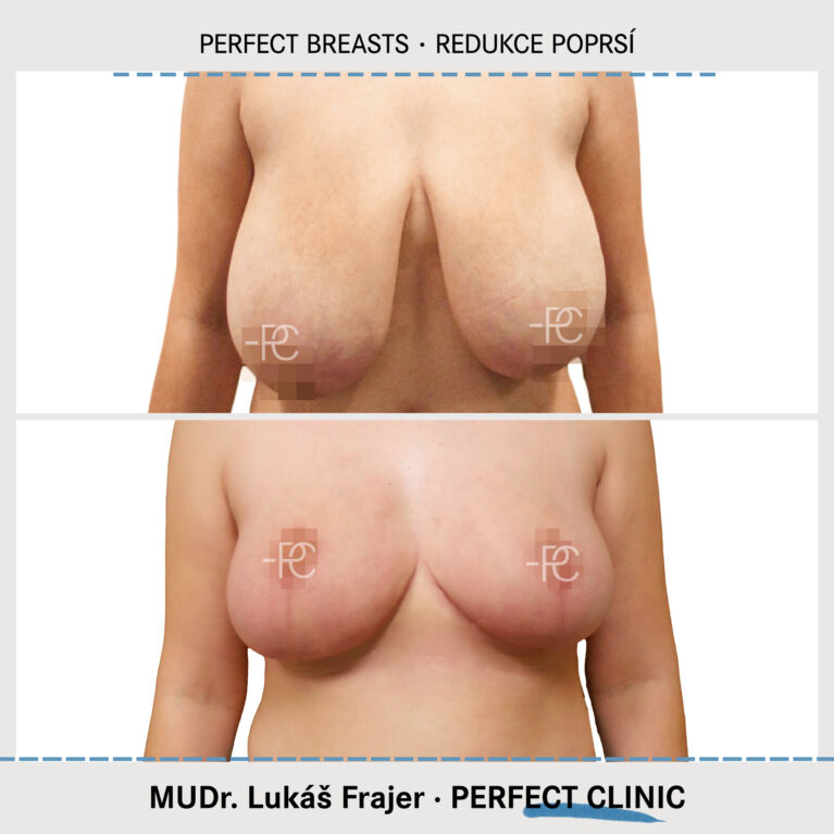 Zmenšení prsou