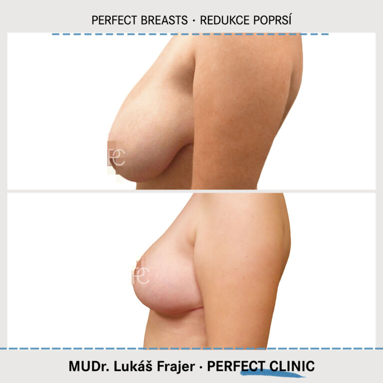 Zmenšení prsou