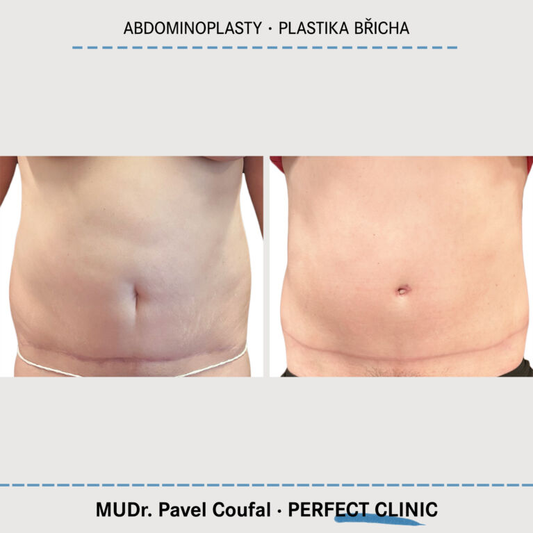 Abdominoplasty