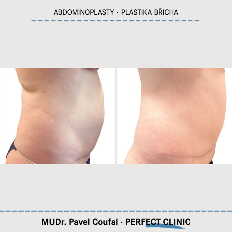 Abdominoplasty