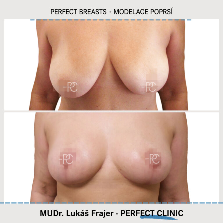 Zmenšení prsou