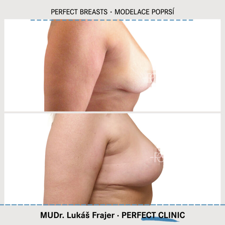 Zmenšení prsou