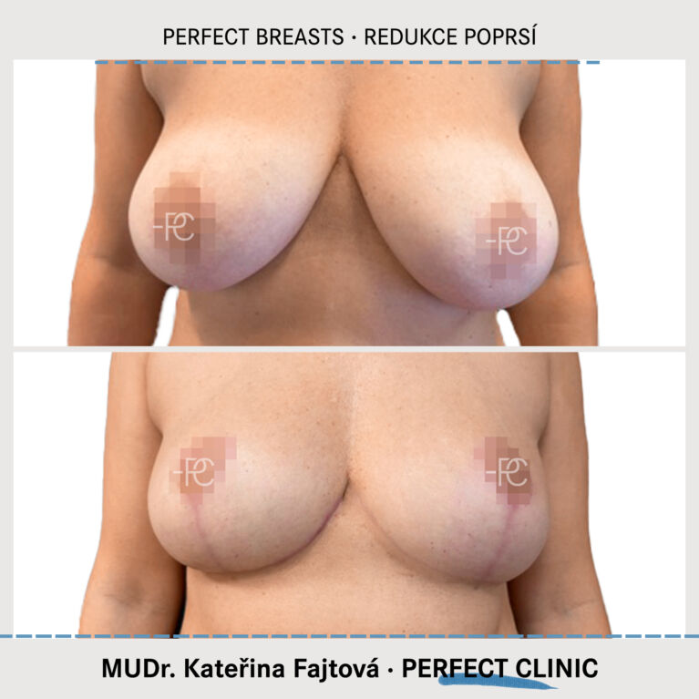 Zmenšení prsou