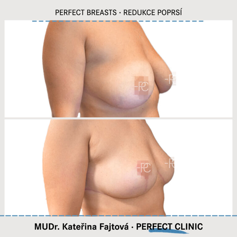 Zmenšení prsou
