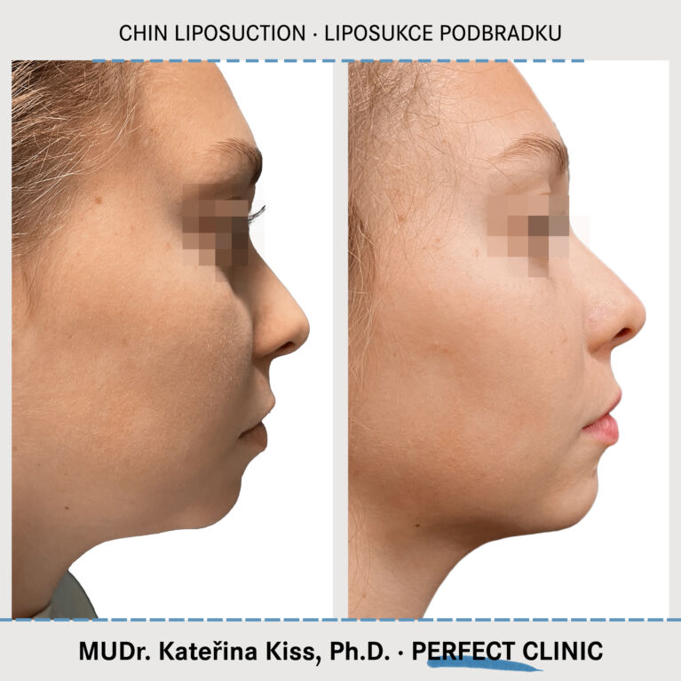 Liposukcja podbródka