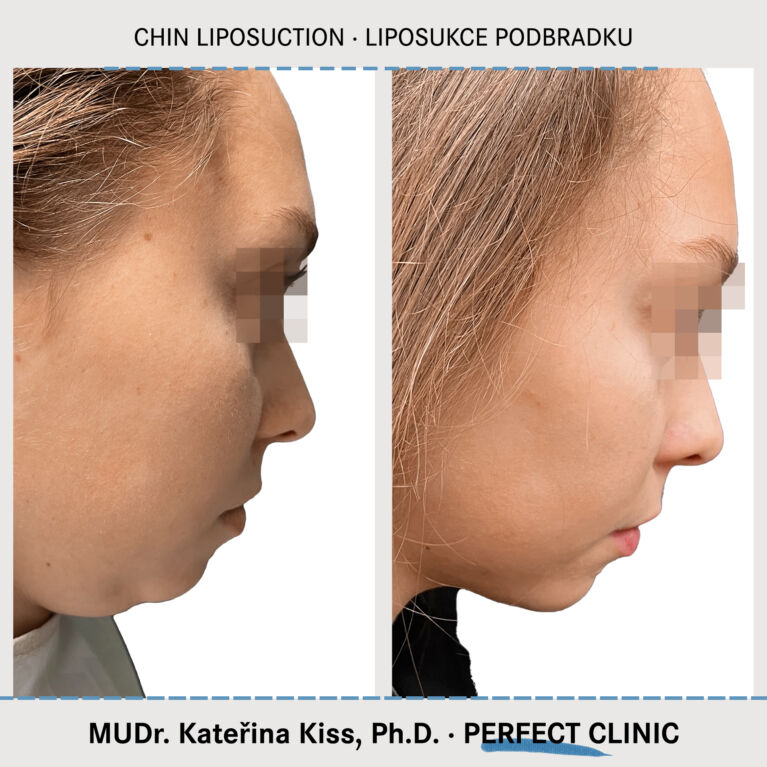 Liposukcja podbródka