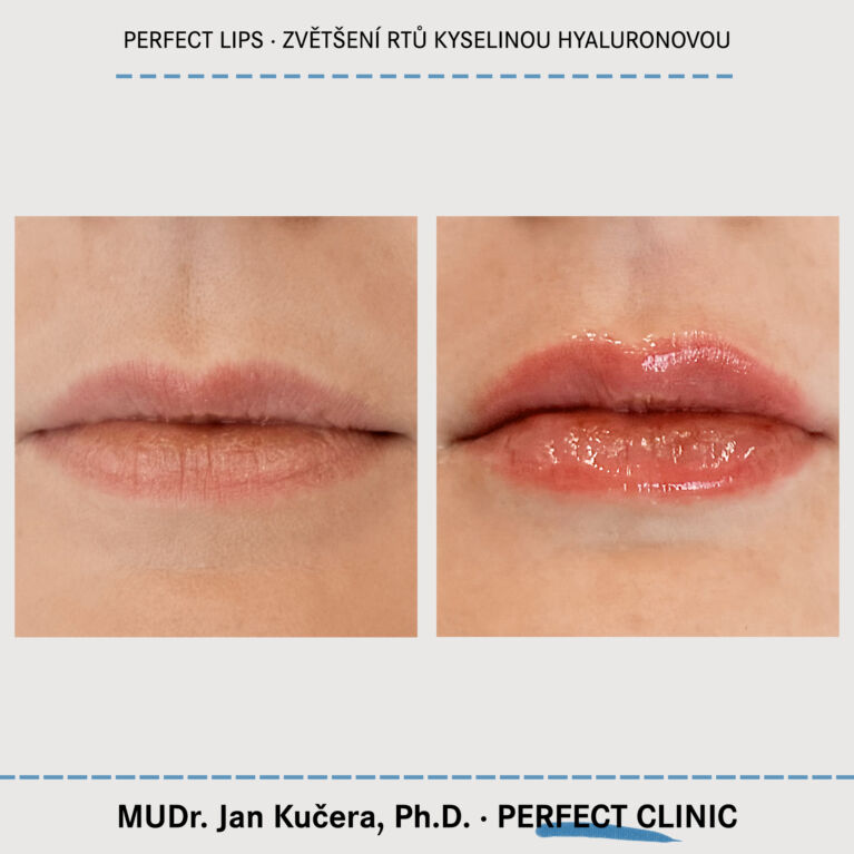 Zvětšení rtů kyselinou hyaluronovou