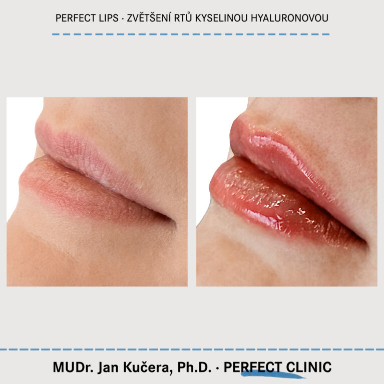 Zvětšení rtů kyselinou hyaluronovou