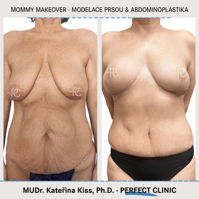 Mommy makeover & Modelace prsou & Abdominoplastika