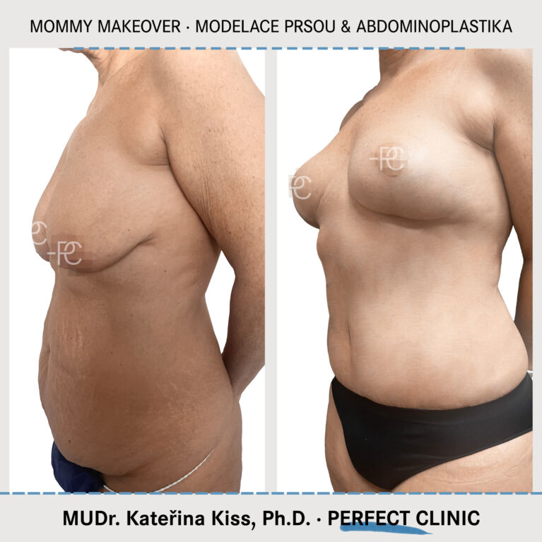 Mommy makeover & Modelace prsou & Abdominoplastika