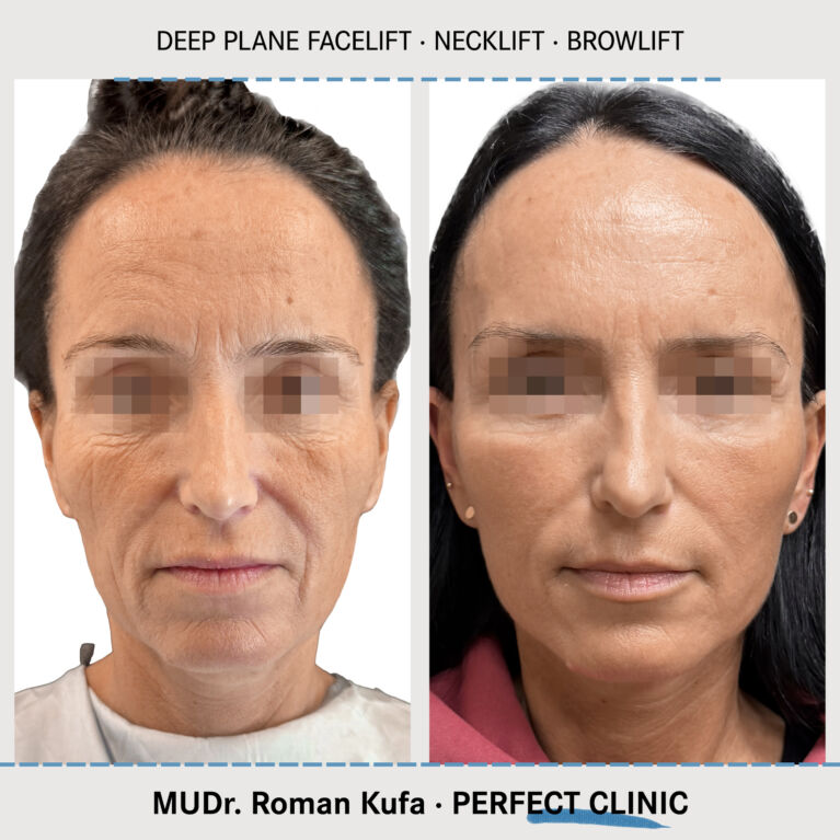 Facelift • Browlift