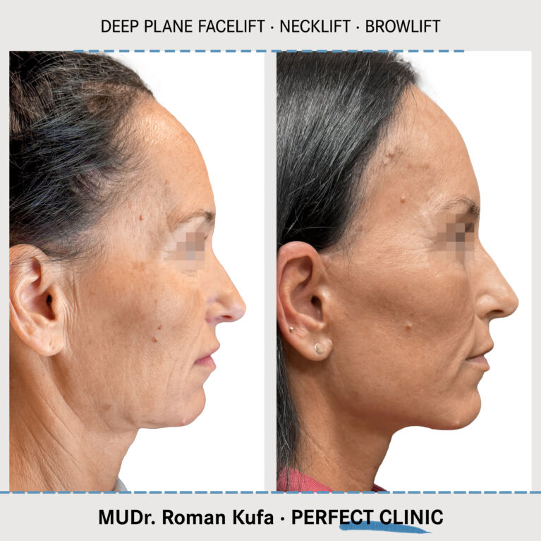 Facelift • Browlift
