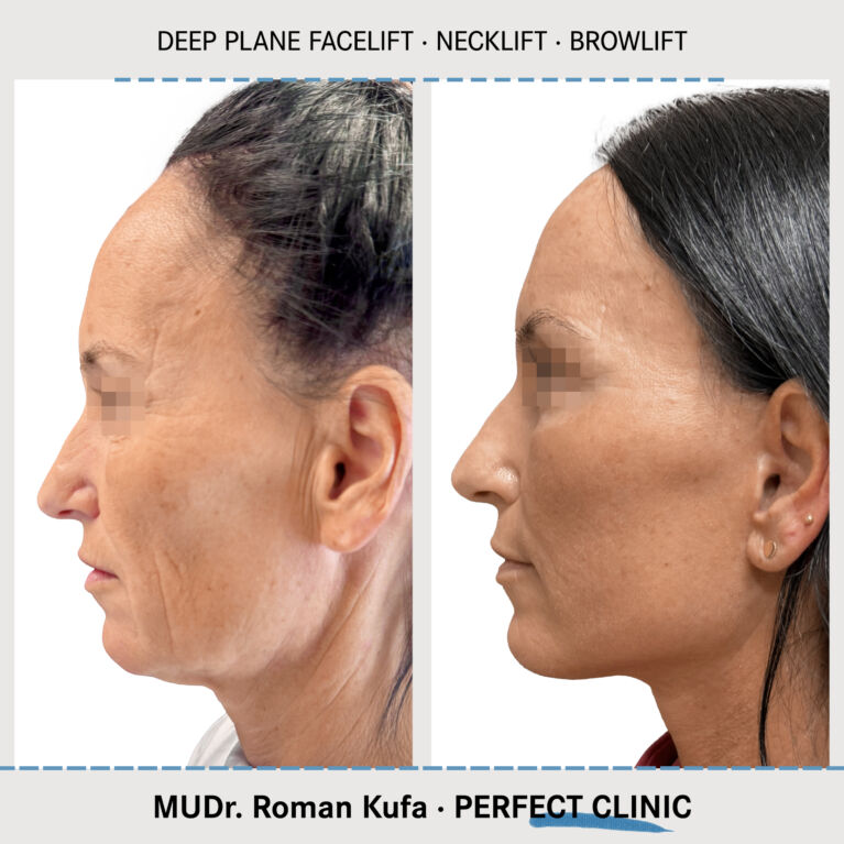 Facelift • Browlift