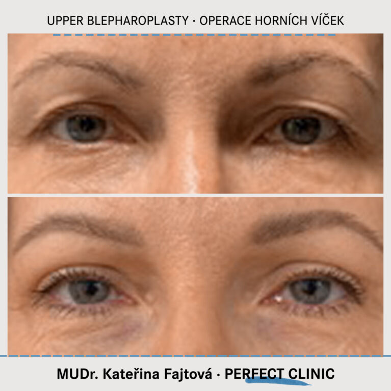 Operace horních víček