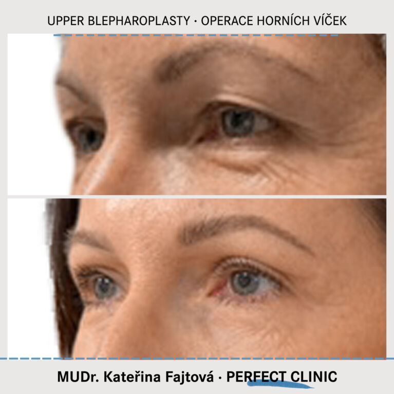 Operace horních víček