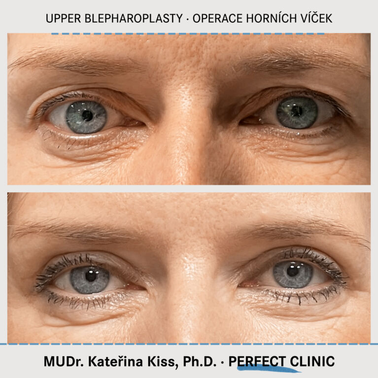 Operace horních víček