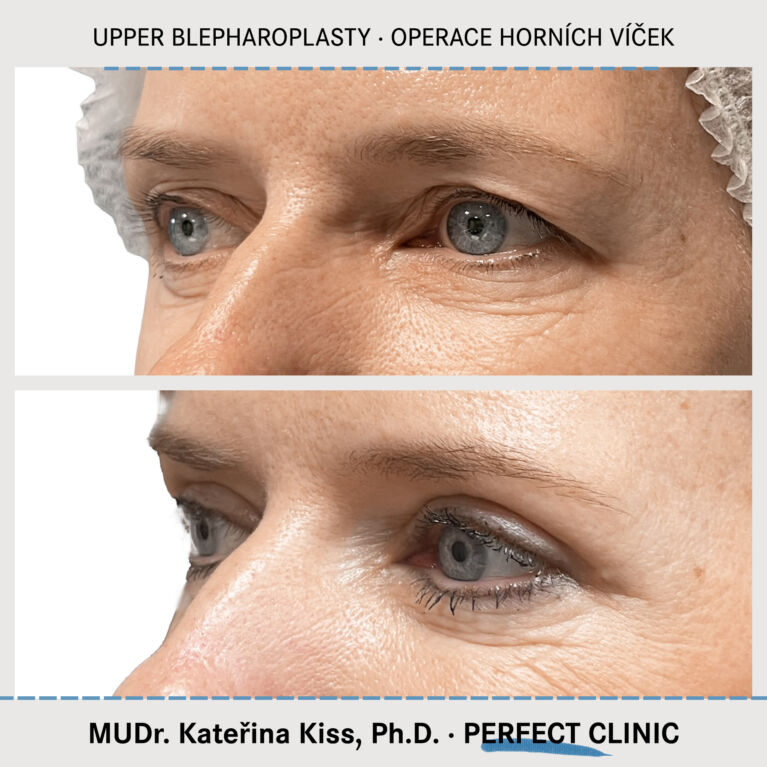 Operace horních víček