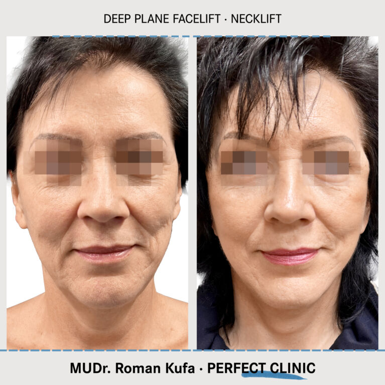 Facelift • Necklift