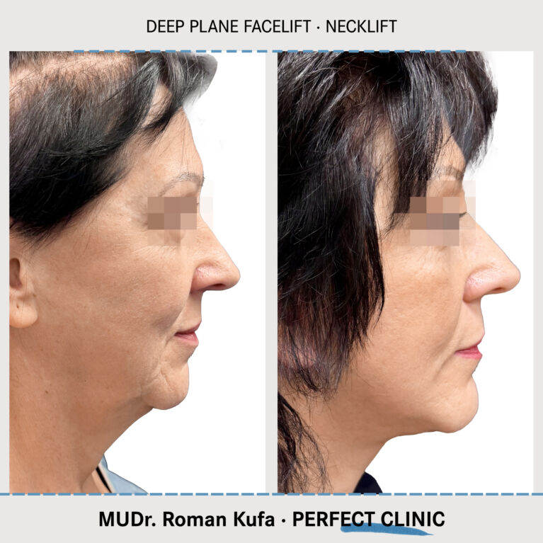 Facelift • Necklift