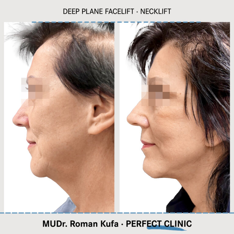 Facelift • Necklift