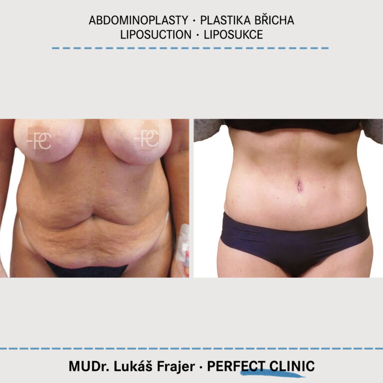 Abdominoplastika & Liposukce
