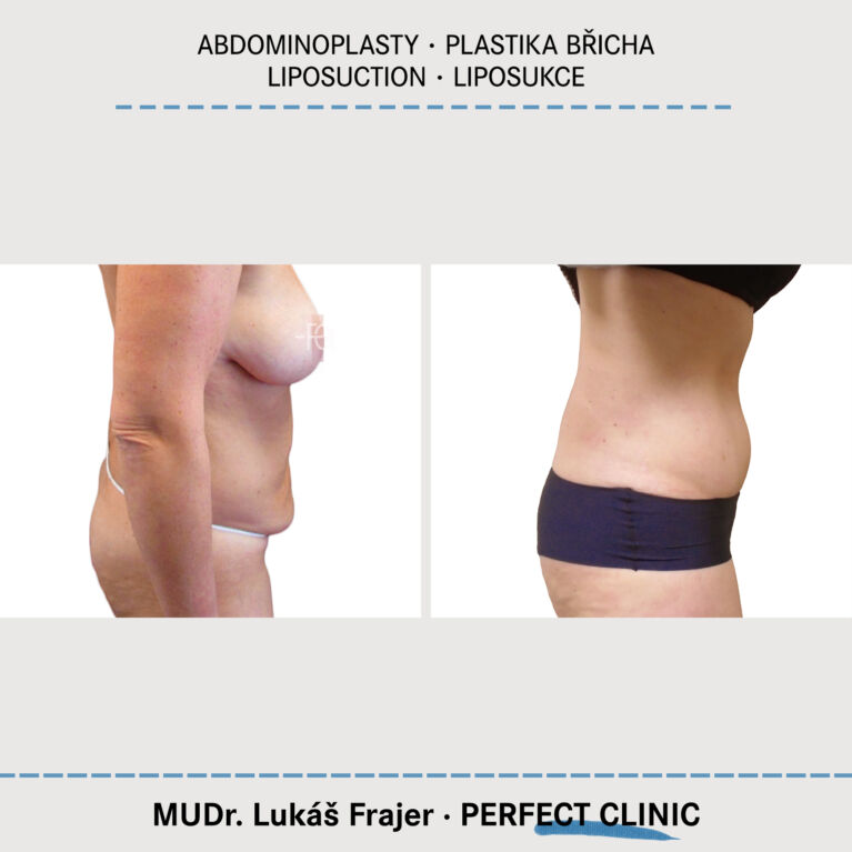 Abdominoplastika & Liposukce