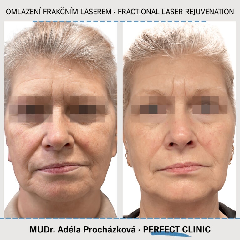 Omlazení frakčním laserem