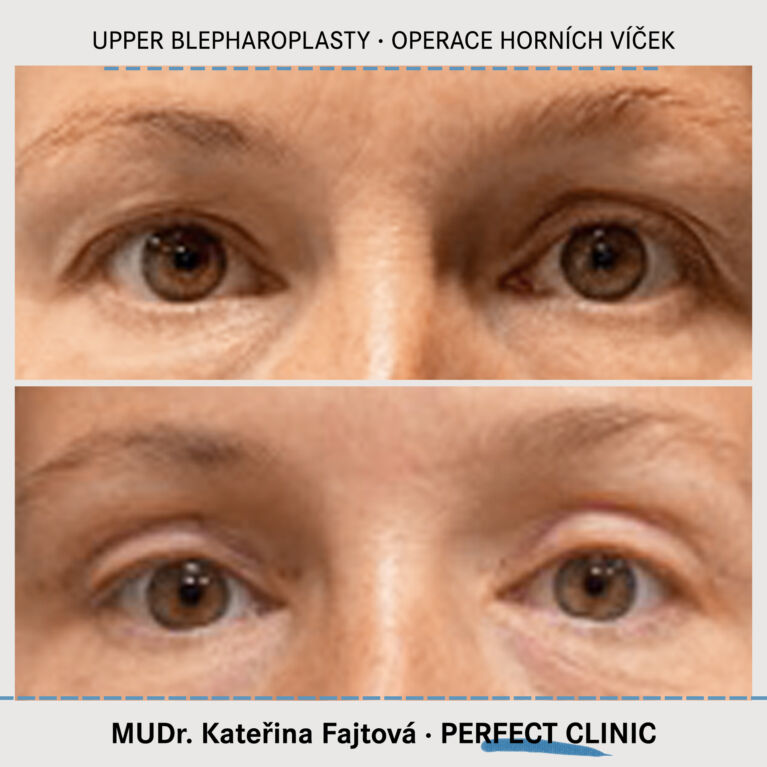Operace horních víček