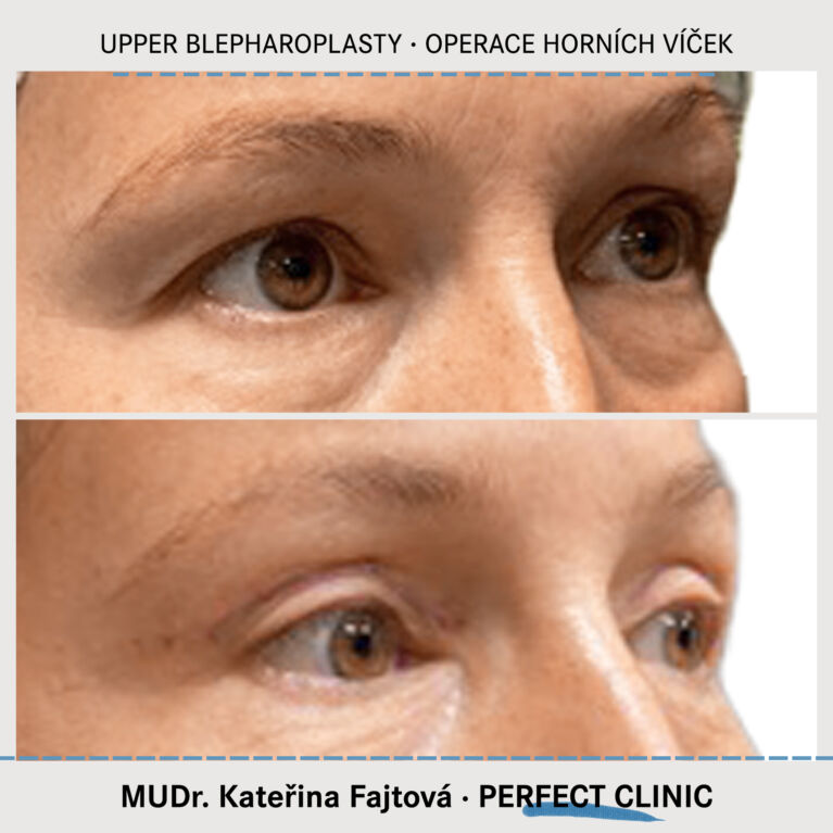 Operace horních víček