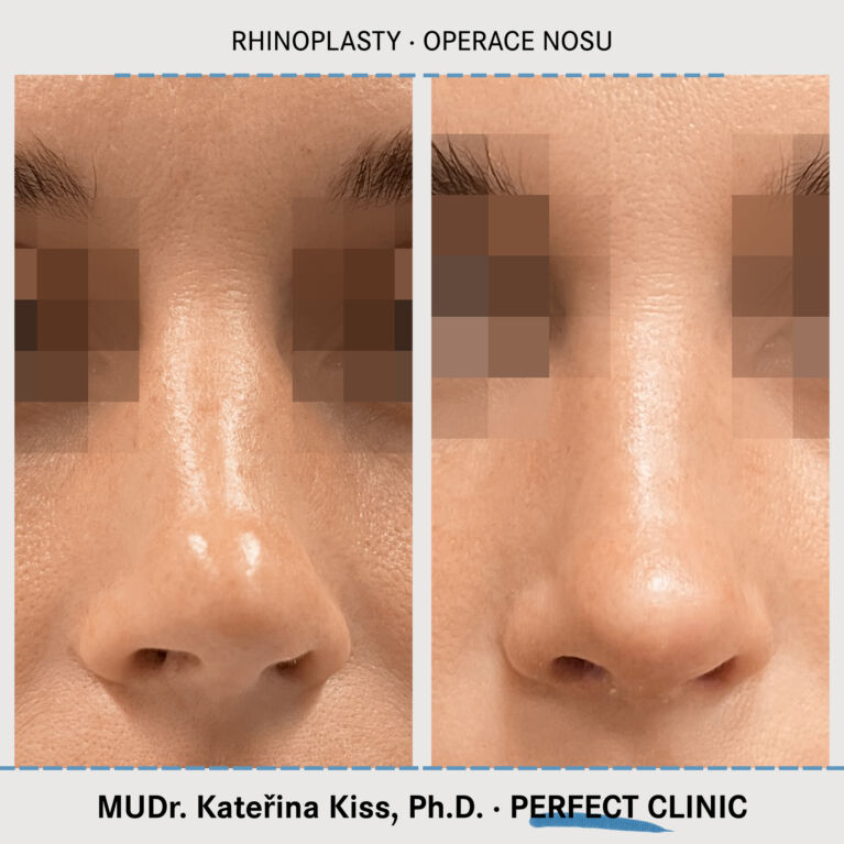 Rhinoplastika