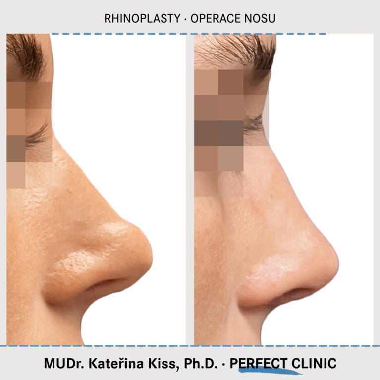 Rhinoplastika