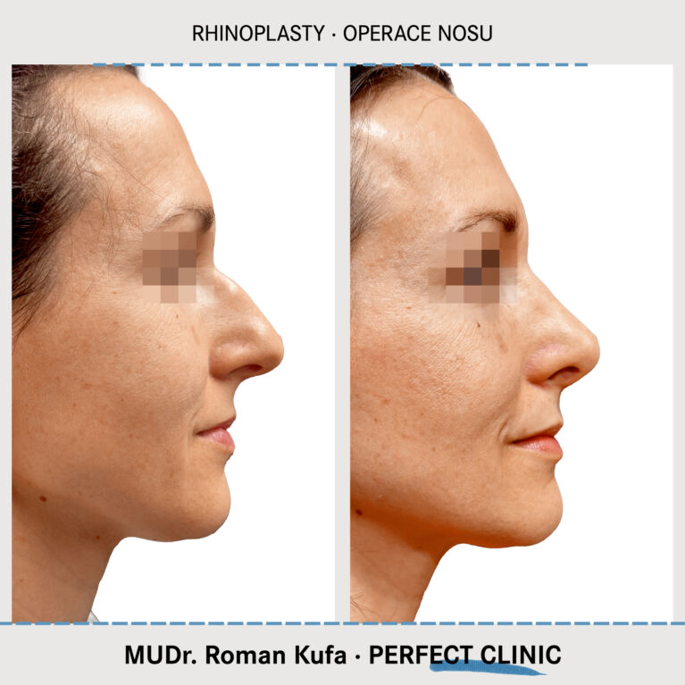 Rhinoplastika