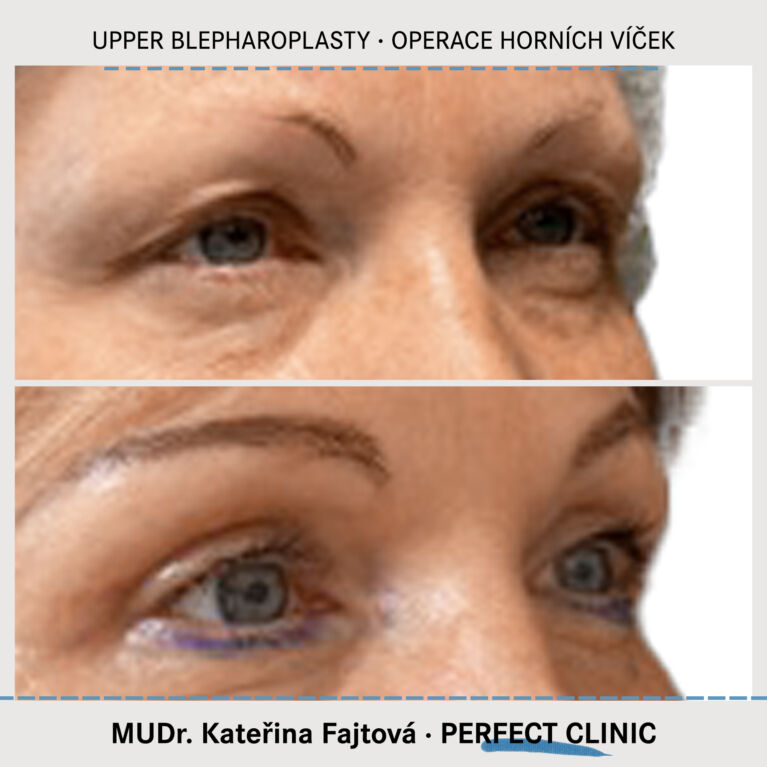 Operace horních víček