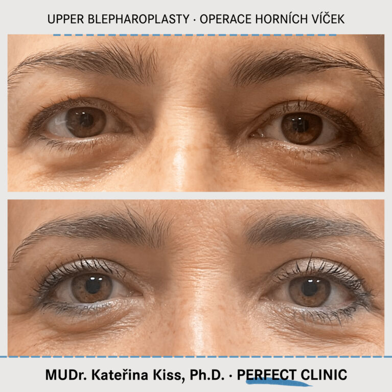 Operace horních víček