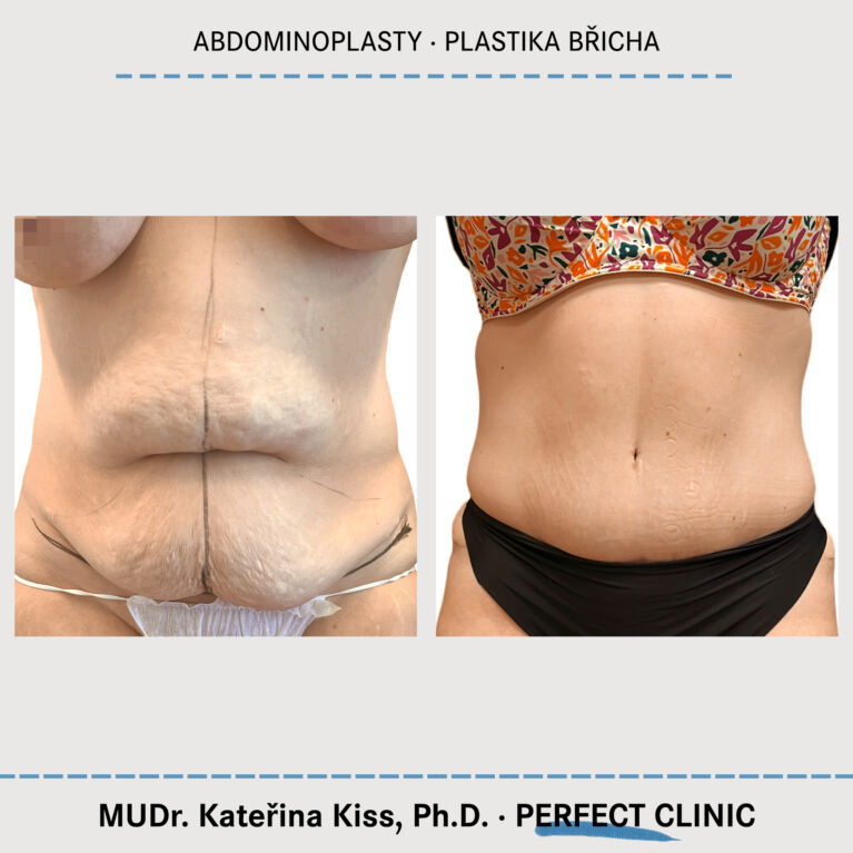 Abdominoplastika