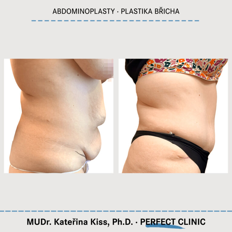 Abdominoplastika