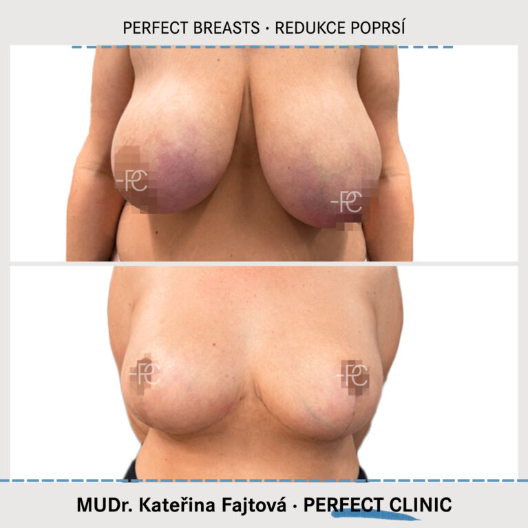 Změnšení prsou