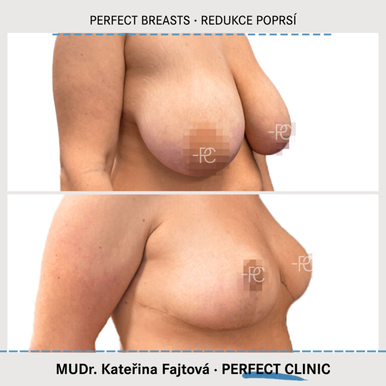 Zmenšení prsou