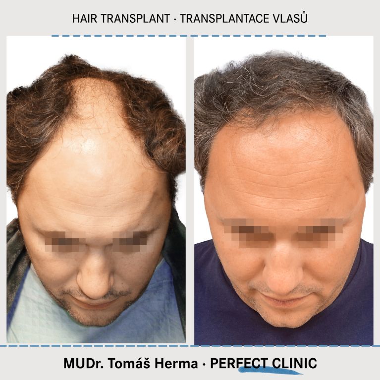 Transplantace vlasů