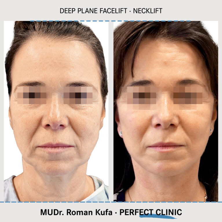 Facelift • Necklift