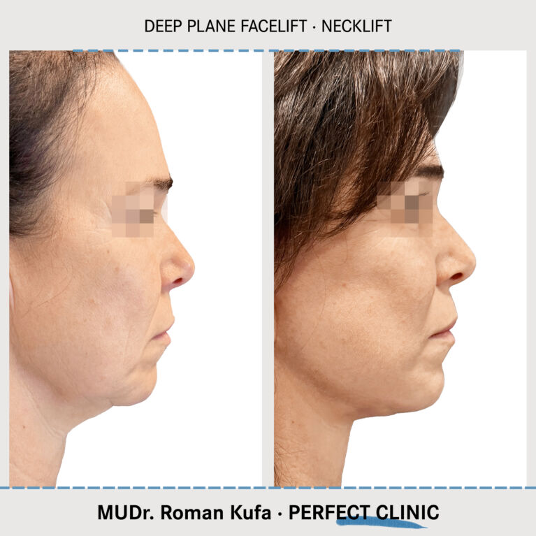 Facelift • Necklift