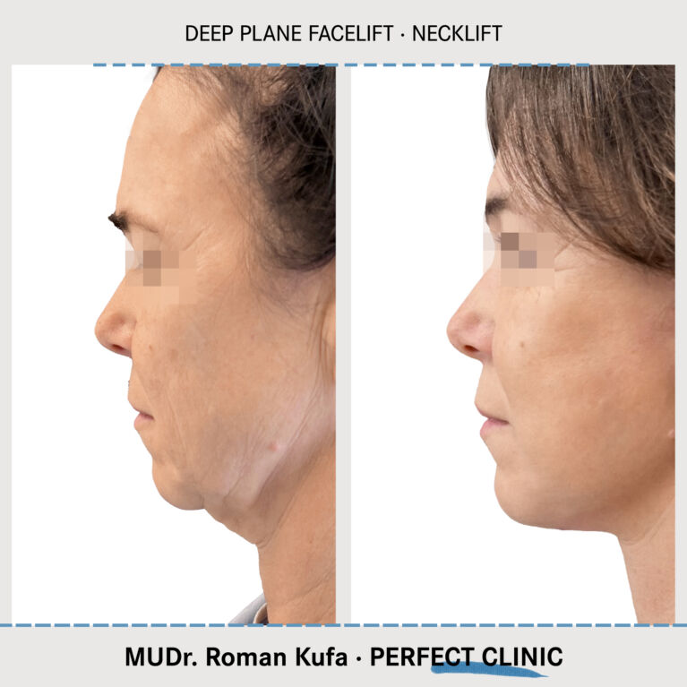 Facelift • Necklift