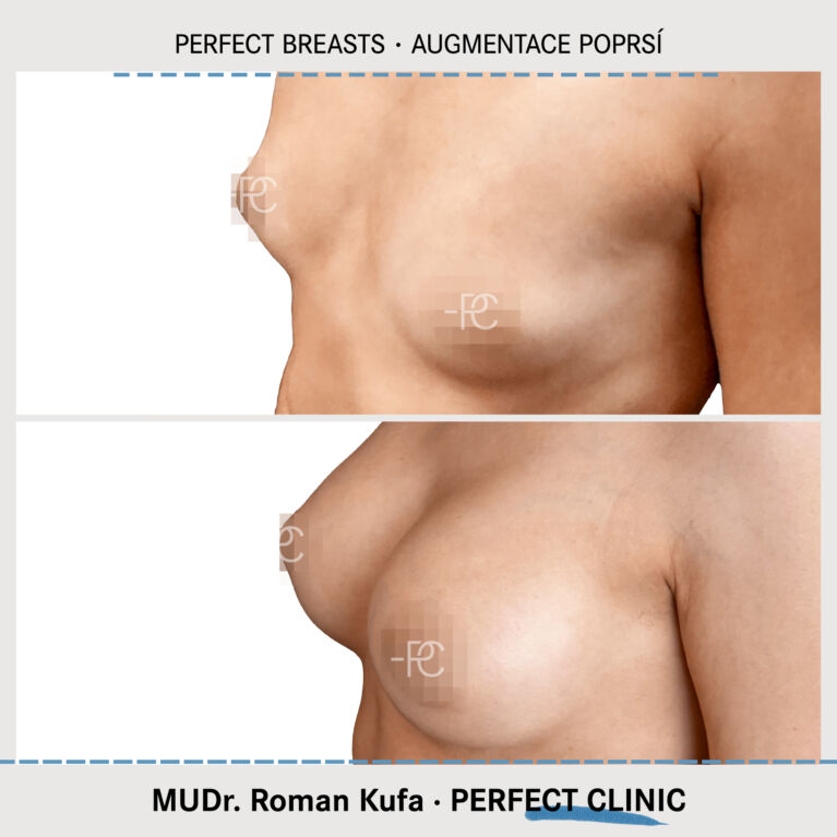 Augmentace poprsí