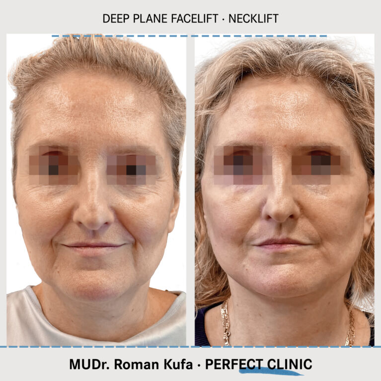 Facelift • Necklift