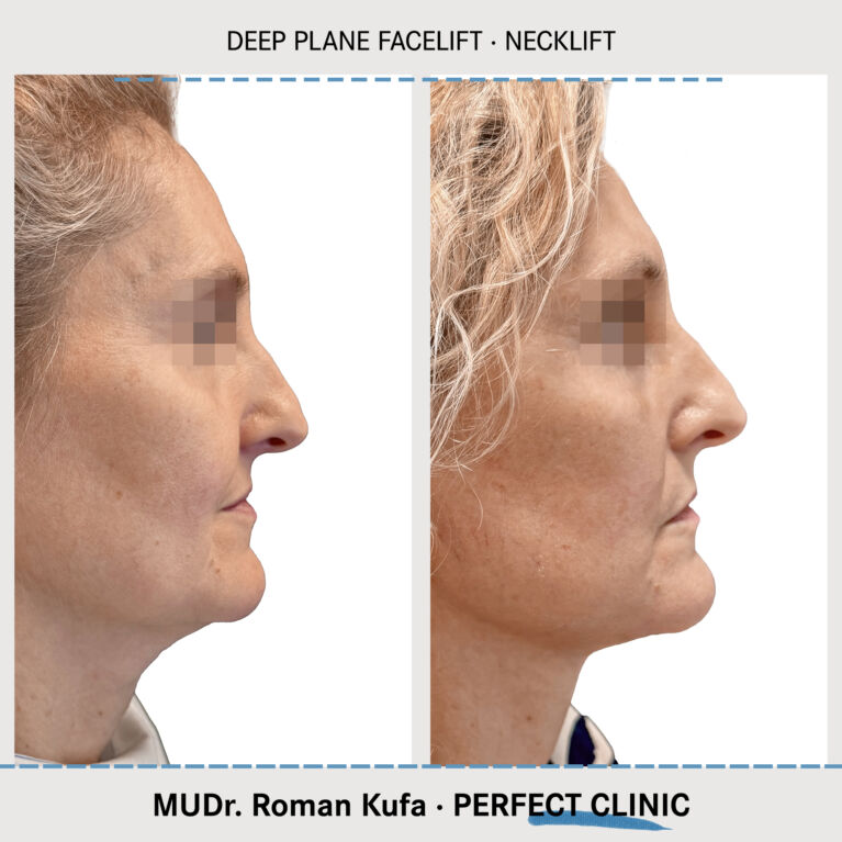 Facelift • Necklift