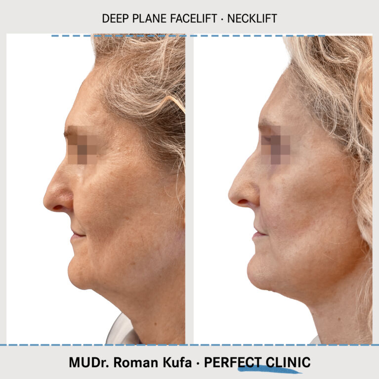 Facelift • Necklift