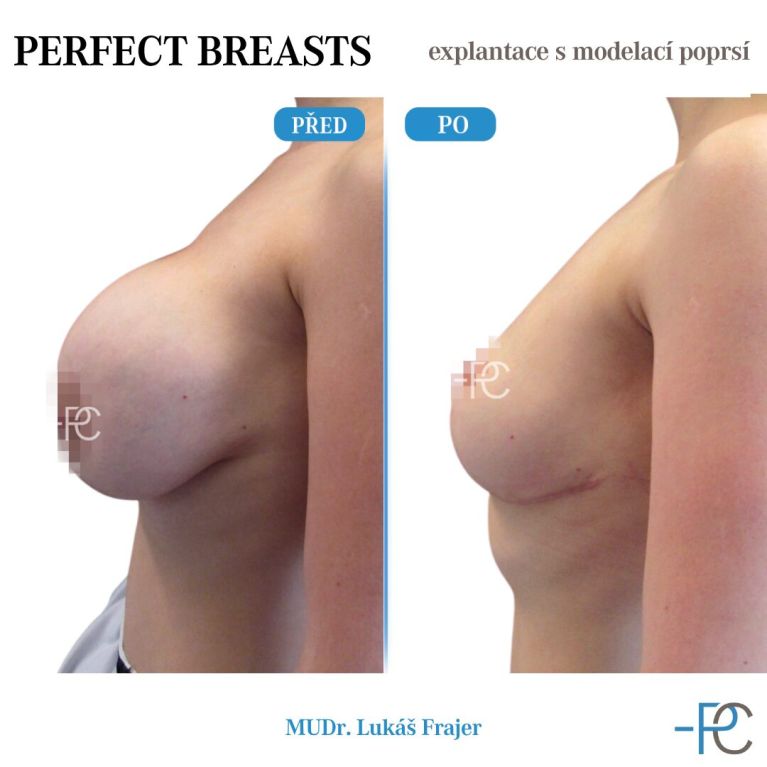 Explantace s modelací poprsí